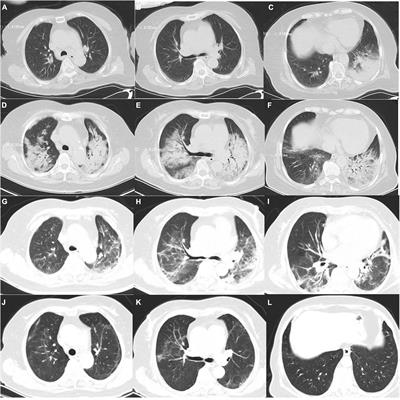 Tigecycline in the treatment of severe pneumonia caused by Chlamydia psittaci: A case report and literature review
